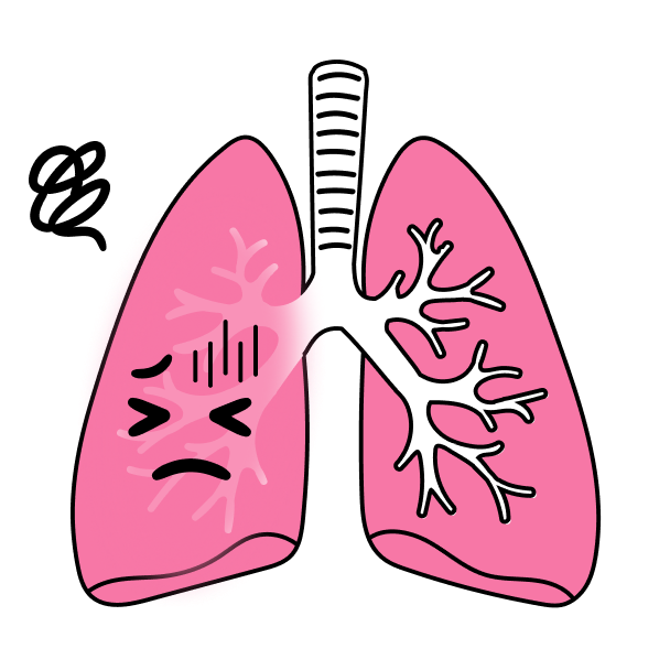 α1-アンチトリプシン欠乏症(AATD)で苦しむ肺のイメージイラスト